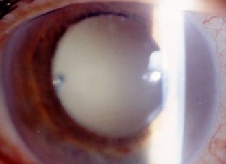Endophthalmitis