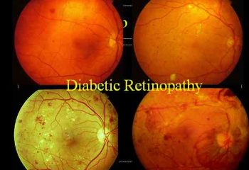 Diabetic Retinopathy Management