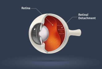 Retinal Detachment