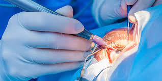 Phacoemulcification Surgery
