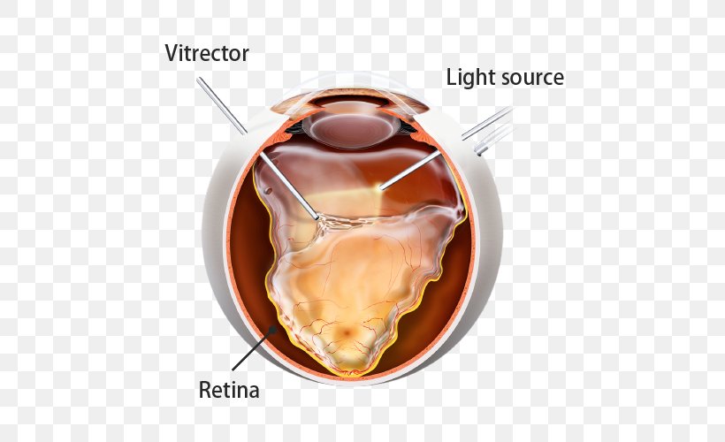 Retina laser treatment diagram