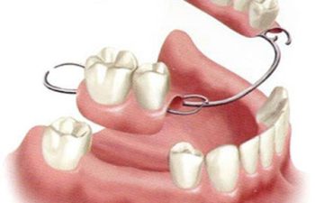 Partial & Complete Denture