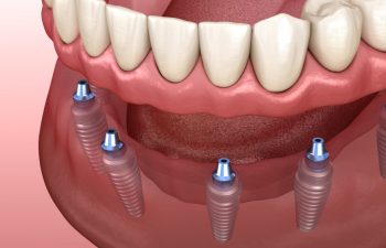 Mandibular prosthesis with gum All on 6 system supported by implants.  Medically accurate 3D illustration of human teeth and dentures concept